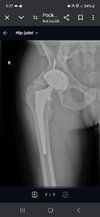 [Bonesmart.org] Heterotopic ossification, not what I expected