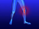 [Bonesmart.org] On road to recovery