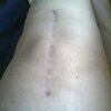 [Bonesmart.org] Onwards and upwards - my journey continues
