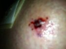 [Bonesmart.org] I have a new knee!