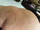[Bonesmart.org] Right TKR, six months post op