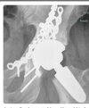 [Bonesmart.org] Noise Issues - Hip Squeak