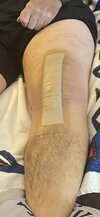 [Bonesmart.org] Knee Scars - Post Your Badges of Honor Here! NO CHIT-CHAT please