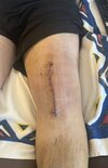 [Bonesmart.org] Knee Scars - Post Your Badges of Honor Here! NO CHIT-CHAT please