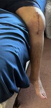 [Bonesmart.org] Slow But Sure Recovery