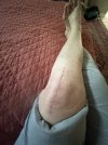 [Bonesmart.org] Knee Scars - Post Your Badges of Honor Here! NO CHIT-CHAT please
