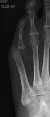 [Bonesmart.org] Patellofemoral PKR with Ehlers Danlos hypermobility