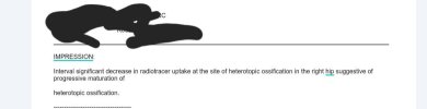 [Bonesmart.org] Heterotopic ossification, not what I expected