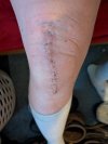 [Bonesmart.org] Knee Scars - Post Your Badges of Honor Here! NO CHIT-CHAT please