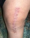 [Bonesmart.org] Knee Scars - Post Your Badges of Honor Here! NO CHIT-CHAT please