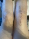[Bonesmart.org] Knee Scars - Post Your Badges of Honor Here! NO CHIT-CHAT please