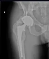 [Bonesmart.org] Heterotopic ossification, not what I expected