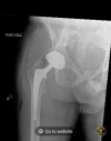 [Bonesmart.org] Heterotopic ossification, not what I expected
