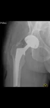 [Bonesmart.org] Heterotopic ossification, not what I expected