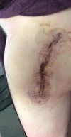 [Bonesmart.org] Hippies scars - post your badges of honor here: NO CHIT-CHAT HERE PLEASE