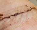 [Bonesmart.org] One RSR down, one to go