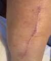 [Bonesmart.org] Knee Scars - Post Your Badges of Honor Here! NO CHIT-CHAT please