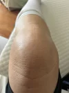 [Bonesmart.org] Knee Scars - Post Your Badges of Honor Here! NO CHIT-CHAT please