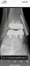[Bonesmart.org] 13 month TAR Surgeon's Appointment
