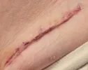 [Bonesmart.org] Shoulder scars - post your badges of honour here: NO CHIT-CHAT HERE PLEASE