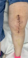 [Bonesmart.org] Knee Scars - Post Your Badges of Honor Here! NO CHIT-CHAT please