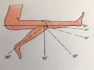 [Bonesmart.org] PT Failure