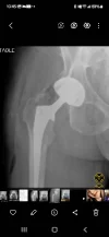 [Bonesmart.org] Heterotopic ossification, not what I expected