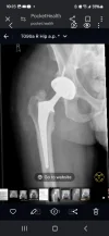 [Bonesmart.org] Heterotopic ossification, not what I expected
