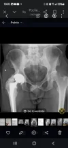 [Bonesmart.org] Heterotopic ossification, not what I expected