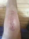 [Bonesmart.org] Knee Scars - Post Your Badges of Honor Here! NO CHIT-CHAT please
