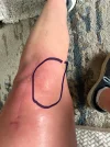 [Bonesmart.org] Patellofemoral PKR with Ehlers Danlos hypermobility