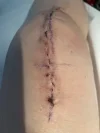 [Bonesmart.org] Knee Scars - Post Your Badges of Honor Here! NO CHIT-CHAT please