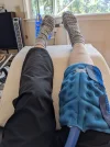 [Bonesmart.org] 2nd TKR - 6/26/2025 - repeating same good BS post op protocols!