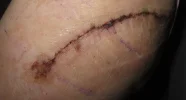 [Bonesmart.org] Hippies scars - post your badges of honor here: NO CHIT-CHAT HERE PLEASE