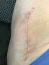 [Bonesmart.org] Hippies scars - post your badges of honor here: NO CHIT-CHAT HERE PLEASE