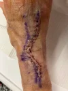 [Bonesmart.org] R Pinkie Extensor Rupture