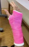 [Bonesmart.org] R Pinkie Extensor Rupture