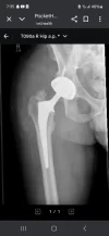 [Bonesmart.org] Heterotopic ossification, not what I expected