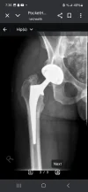 [Bonesmart.org] Heterotopic ossification, not what I expected