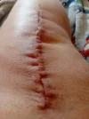 [Bonesmart.org] Hello Everyone - First time knee replacement patient here : )