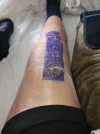 [Bonesmart.org] TKR2019 Revision 2021 Now possible infection