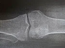 [Bonesmart.org] Moving forward.