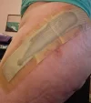 [Bonesmart.org] On the other side of surgery