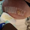 [Bonesmart.org] On the other side of surgery