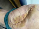 [Bonesmart.org] Hippies scars - post your badges of honor here: NO CHIT-CHAT HERE PLEASE