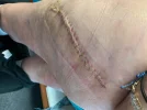 [Bonesmart.org] Hippies scars - post your badges of honor here: NO CHIT-CHAT HERE PLEASE