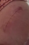 [Bonesmart.org] On the other side of surgery