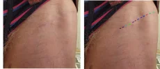 [Bonesmart.org] Hippies scars - post your badges of honor here: NO CHIT-CHAT HERE PLEASE