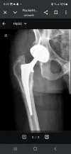 [Bonesmart.org] Heterotopic ossification, not what I expected
