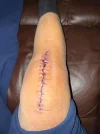 [Bonesmart.org] Knee Scars - Post Your Badges of Honor Here! NO CHIT-CHAT please